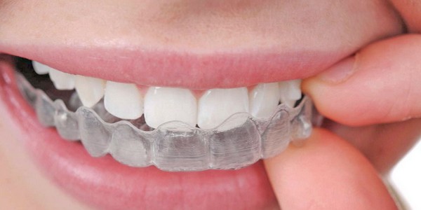 Los beneficios de la ortodoncia invisible
